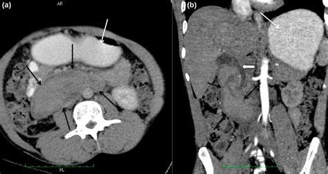 Figure 1 From A Case Of Spontaneous Intramural Duodenal Hematoma In A