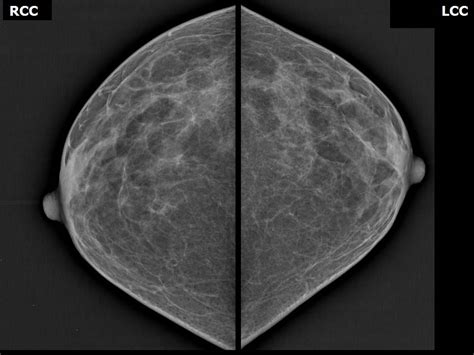Atlas Of Breast Cancer Early Detection