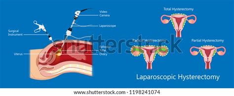 laparoscopic hysterectomy medical surgical treat cervix ovary subtotal ...