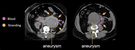 Abdominal Ct Aortic Aneurysm • Litfl • Radiology Library