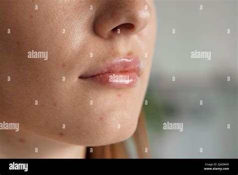 Closeup Acne On Woman Face With Rash Skin Selective Focus Stock Photo