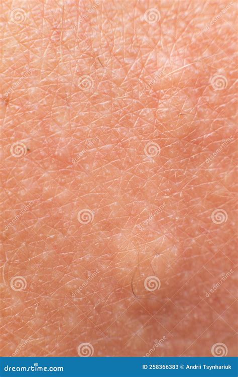 Swollen Bee Sting Site Redness On The Skin From A Bee Sting Stock