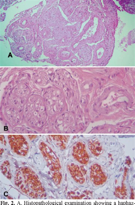 Traumatic Neuroma Histopathology