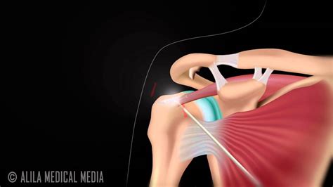 Arthroscopic Subacromial Decompression YouTube