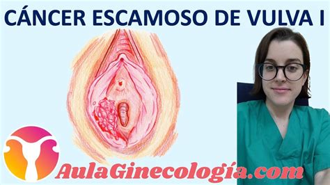 Ppt Cancer De Vulva Dra Jesica Gabutti Neoplasia Intraepitelial De