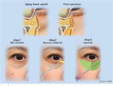 Lower Blepharoplasty Procedure