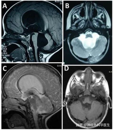 脑积水是什么原因引起的起的 知乎