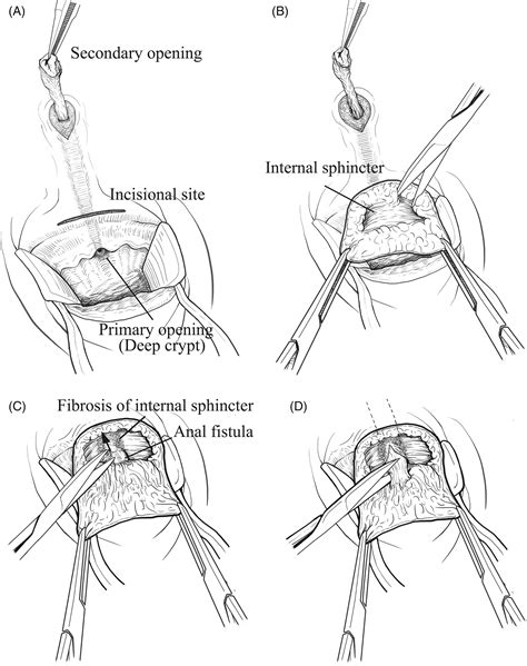 Subcutaneous Incision Of The Fistula Tract And Internal Sphincterotomy