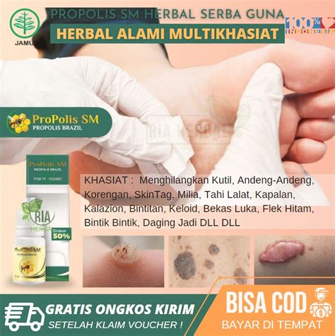 Salep Penghilang Keloid Hilangkan Keloid Membesar Dan Gatal Obat