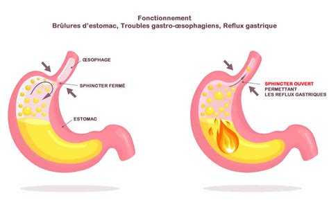 Sympt Mes Du Reflux Gastrique