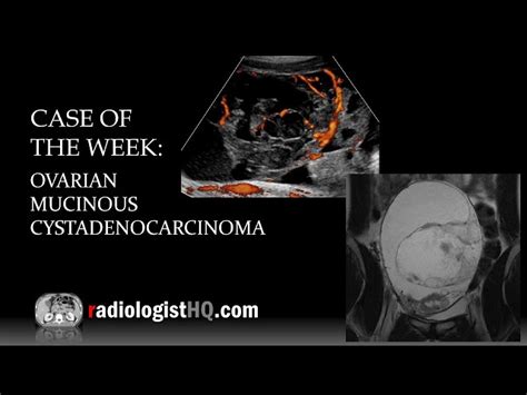 Mucinous Cystadenoma Ultrasound