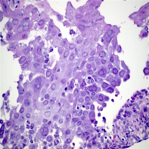 Pathology Outlines Hsv Esophagitis