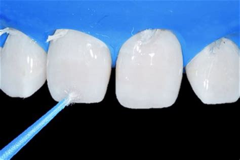 Transformação Do Sorriso Por Meio De Fechamento De Diastema Utilizando