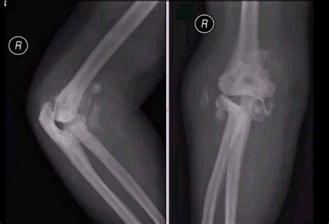 Charcot Joint Radiology Case Radiologystar