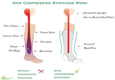Zip Compression Socks | Zip the pain away | Baron Active