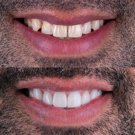 A dazzling smile doesn't only light up your face; it brightens your