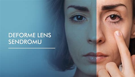 Intraocular Lens Treatments Veni Vidi Eye