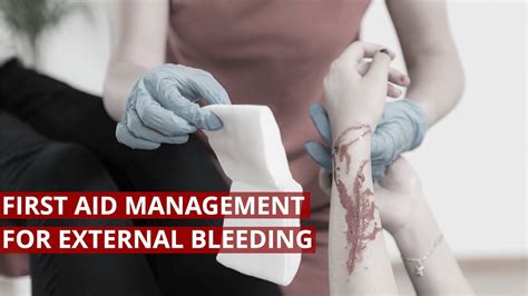 First Aid For Severe Bleeding Imbalife