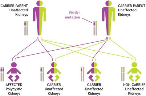 Schematic Of The Autosomal Recessive Inherited Pattern That Caroli