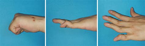 swan neck deformity  tendinous mallet finger     year