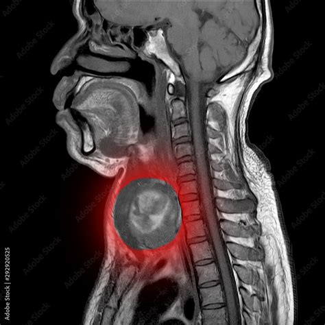 Magnetic Resonance Imaging Mri Of Neck Sagittal View A Case Of Neck Impression Deep Neck