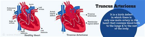 Truncus Arteriosus Types Risk Factors Clinical Features Management