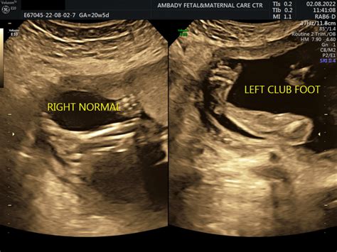 What is clubfoot in babies | Ambady Scan center Thrissur