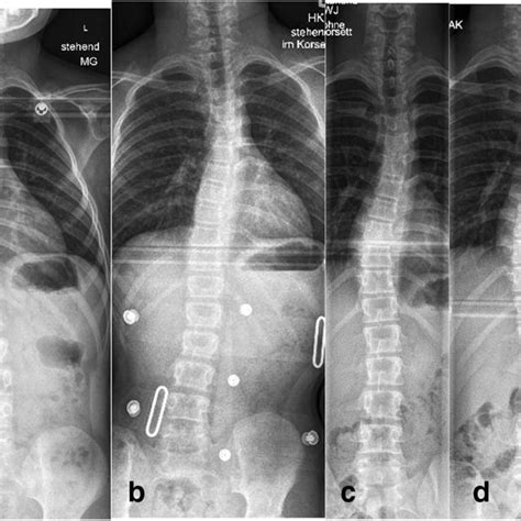 Case 2 Eight Year Old Patient With An “idiopathic Like” Early Onset