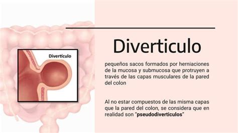 Enfermedad Diverticular Del Colón Cx Pptx