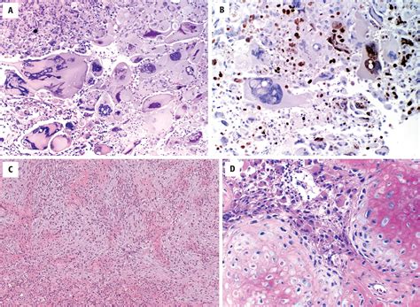 Glial And Glioneuronal Tumors Clinical Tree