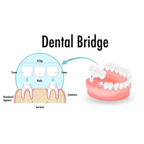 Dental Bridge In Richmond, Texas | Glow Up Dentistry