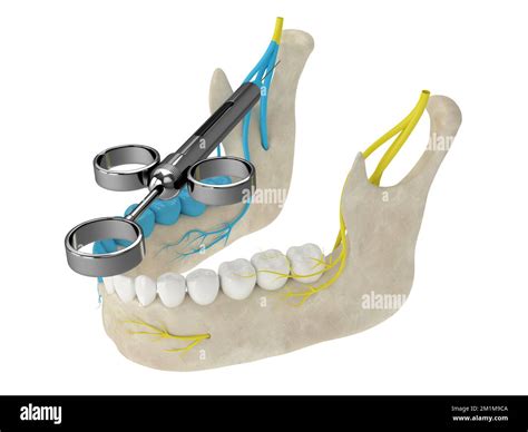 D Render Of Mandibular Arch With Gow Gates Nerve Block Types Of