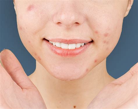 June Is Acne Awareness Month Advice For Effective Acne Prevention