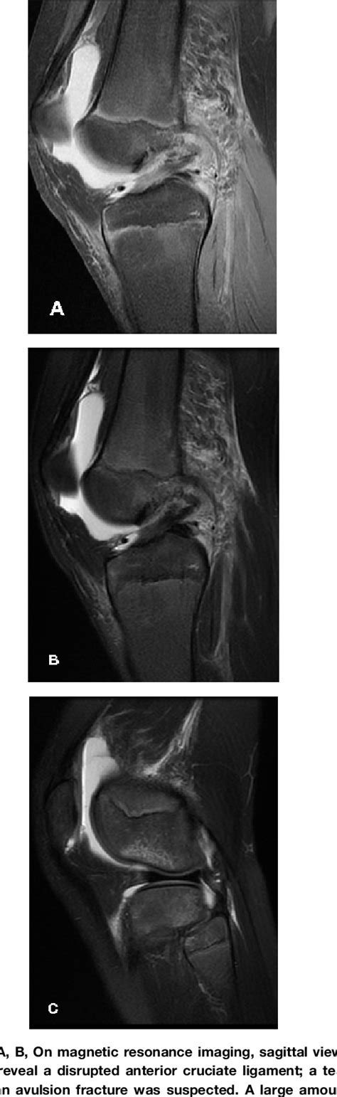 Figure 1 From Osteochondral Avulsion Fracture Of The Anterior Cruciate