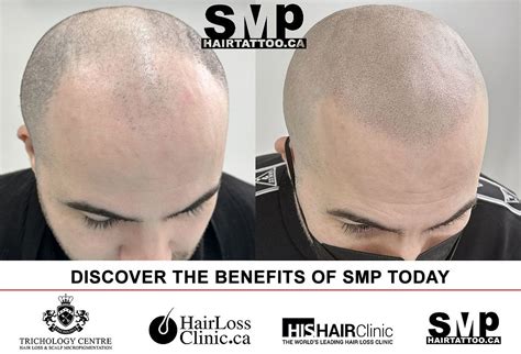 Comprehensive Guide To Scalp Tattoo And Hairline Tattoo Hairtattooca