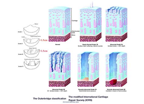 Cartilage Treatment Cartilage Cell Therapy Regrow