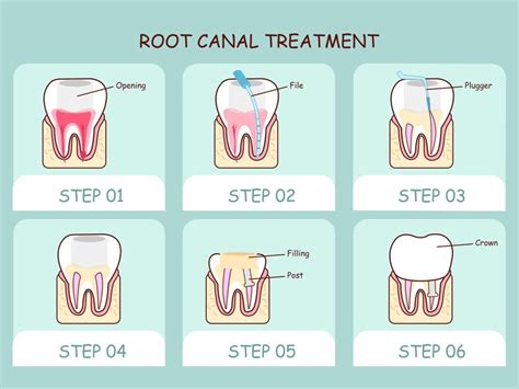 How long is root canal recovery?