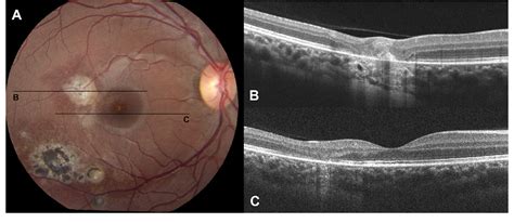 Spectral Oct Retina