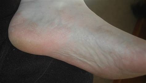 athletes foot flickr photo sharing