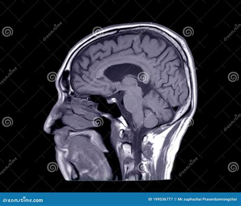 MRI of the Brain Sagittal T1 View Stock Illustration - Illustration of ...