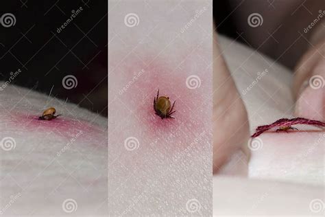 Tick With Its Head Sticking In Human Skin Stock Photo Image Of