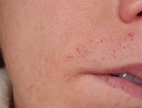 Red Spots On The Upper Lip Infoupdate Org