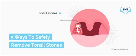 5 Safe And Effective Ways To Remove And Prevent Tonsil Stones