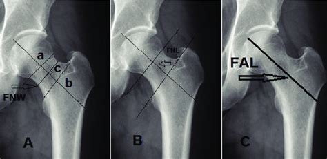 A The Femoral Neck Width Fnw Which Is The Mid Point Distance Download Scientific Diagram