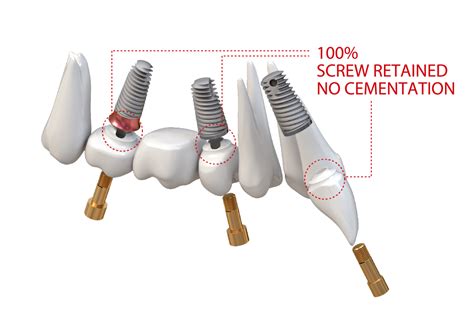 Tri Dental Implants Digital Implant