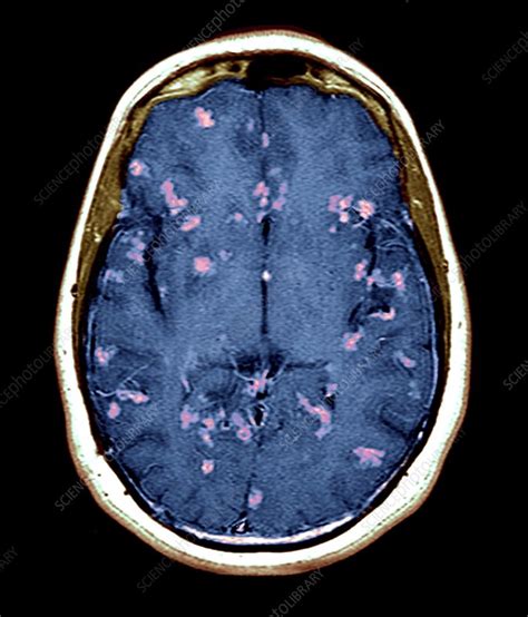 Diseased Brain Mri Scan Stock Image C Science Photo Library