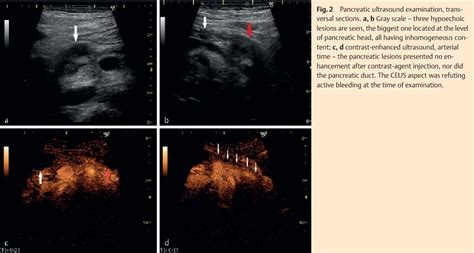 Figure 1 From Chronic Pancreatitis With Hemosuccus Pancreaticus The