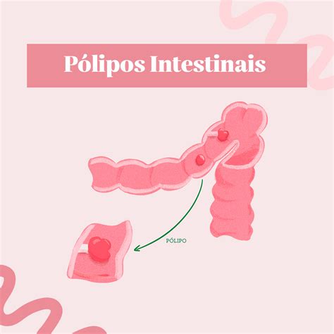 O Que Sao Polipos Intestino