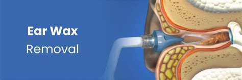 Safe Ear Wax Removal Techniques