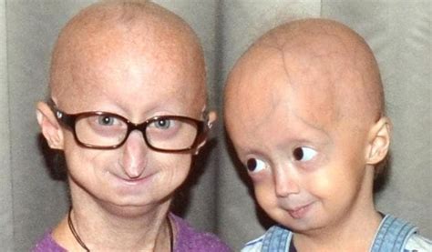 Zokinvy First Drug For Progeria A Rare Rapid Aging Disease Extends
